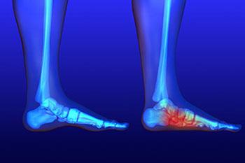 Flat Foot Treatment  Foot Doctor Encino, CA 91316 and Los Angeles, CA 90025