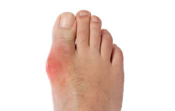 gout treatment in the Encino, CA 91316 and Los Angeles, CA 90049 areas