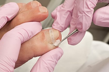 ingrown toenails treatment in the Encino, CA 91316 and Los Angeles, CA 90049 areas