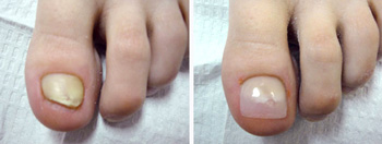 keryflex nail restoration treatment in the Encino, CA 91316 and Los Angeles, CA 90049 areas