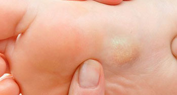 plantar fibroma treatment in the Encino, CA 91316 and Los Angeles, CA 90049 areas