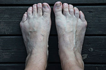 tailors bunions treatment in the Encino, CA 91316 and Los Angeles, CA 90049 areas